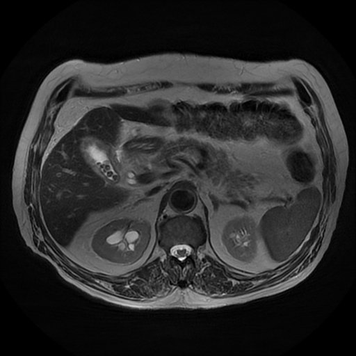 File:Acute cholecystitis complicated by pylephlebitis (Radiopaedia 65782-74915 Axial T2 18).jpg