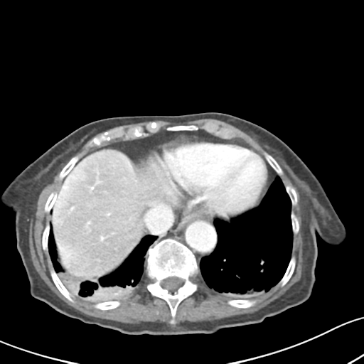 Acute cholecystitis with contained perforation (Radiopaedia 47328-51907 Axial C+ portal venous phase 9).png