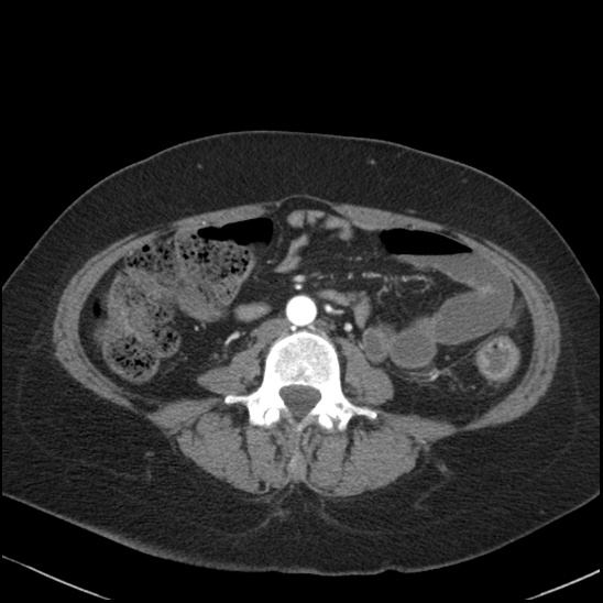 Acute colonic hemorrhage in ulcerative colitis (Radiopaedia 77415-89538 Axial C+ arterial phase 75).jpg