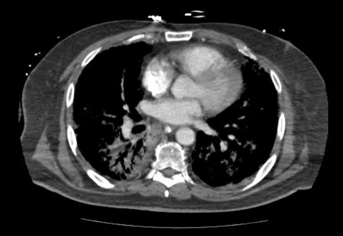 File:Acute cor pulmonale (ultrasound) (Radiopaedia 83508-98818 Axial C+ CTPA 45).jpg