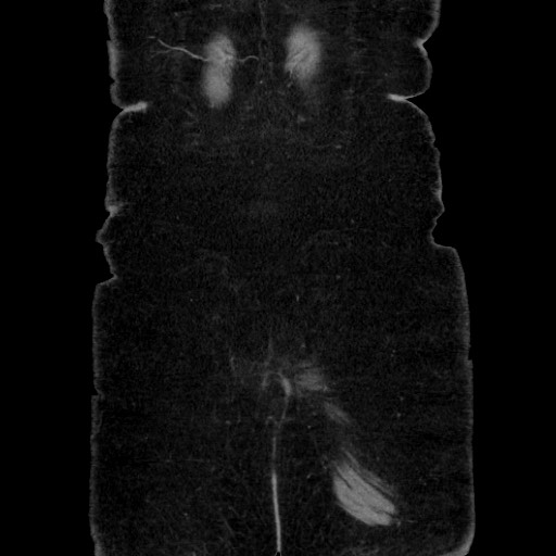 Acute diverticulitis - transverse colon (Radiopaedia 87063-103327 Coronal C+ portal venous phase 152).jpg