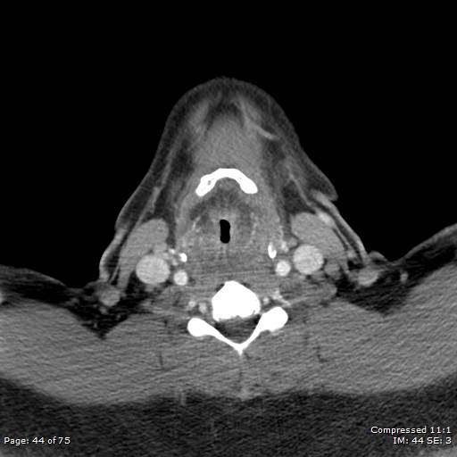 Acute epiglottitis (Radiopaedia 54375-60590 Axial C+ arterial phase 44).jpg