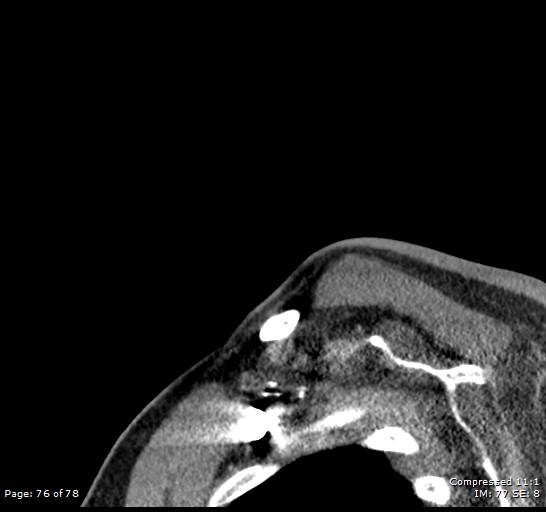 Acute epiglottitis (Radiopaedia 54375-60590 Sagittal C+ arterial phase 76).jpg
