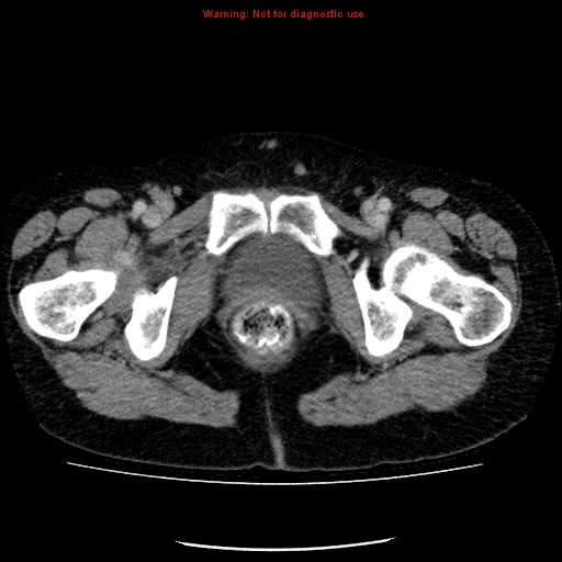 Acute gangrenous cholecystitis (Radiopaedia 10123-10661 Axial C+ portal venous phase 102).jpg