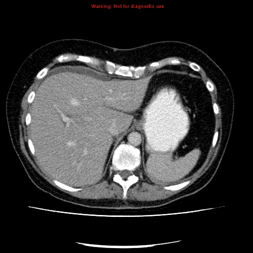 File:Acute gangrenous cholecystitis (Radiopaedia 10123-10661 Axial C+ portal venous phase 19).jpg