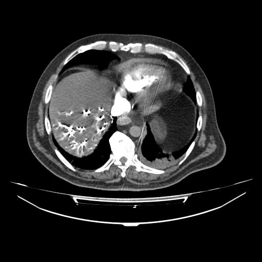 Acute heart failure (CT) (Radiopaedia 79835-93075 Axial C+ arterial phase 53).jpg