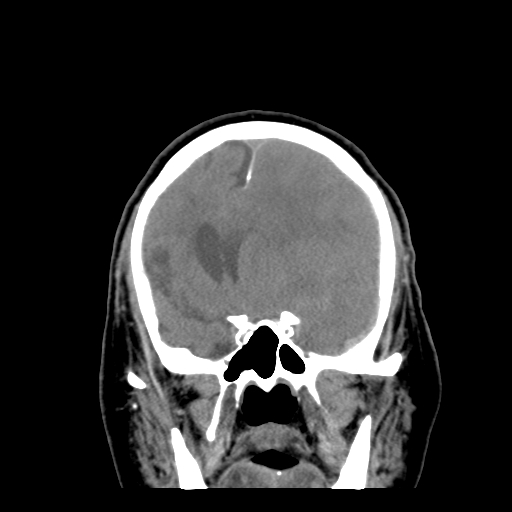 Acute hemorrhagic stroke (Radiopaedia 17507-17223 Coronal non-contrast 19).jpg