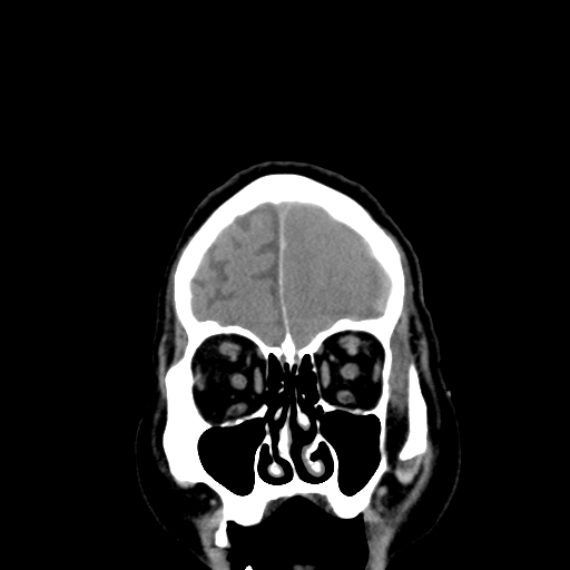 Acute hemorrhagic stroke (Radiopaedia 17507-17223 Coronal non-contrast 7).jpg