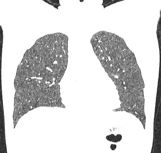 Acute hypersensitivity pneumonitis (Radiopaedia 85293-100870 Coronal lung window 41).jpg