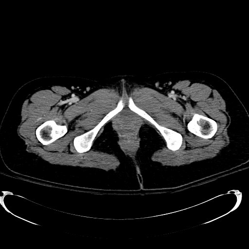 Acute myocardial infarction in CT (Radiopaedia 39947-42415 Axial C+ portal venous phase 145).jpg