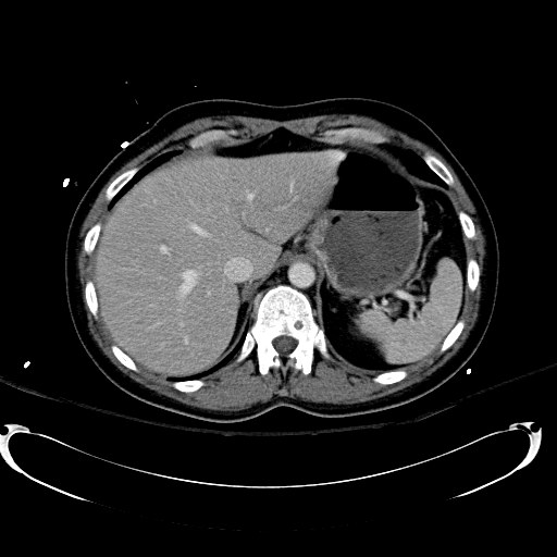 File:Acute myocardial infarction in CT (Radiopaedia 39947-42415 Axial C+ portal venous phase 27).jpg