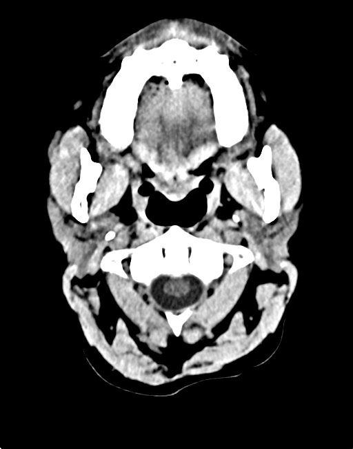 Acute on chronic subdural hematoma (Radiopaedia 74814-85823 Axial non-contrast 19).jpg