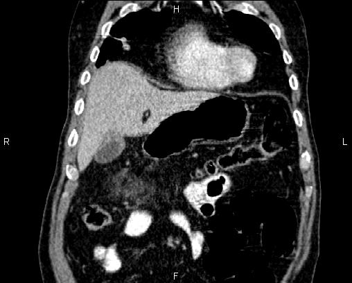 Acute pancreatitis (Radiopaedia 85146-100701 Coronal C+ portal venous phase 14).jpg