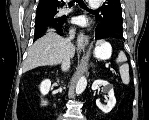 Acute pancreatitis (Radiopaedia 85146-100701 Coronal C+ portal venous phase 46).jpg