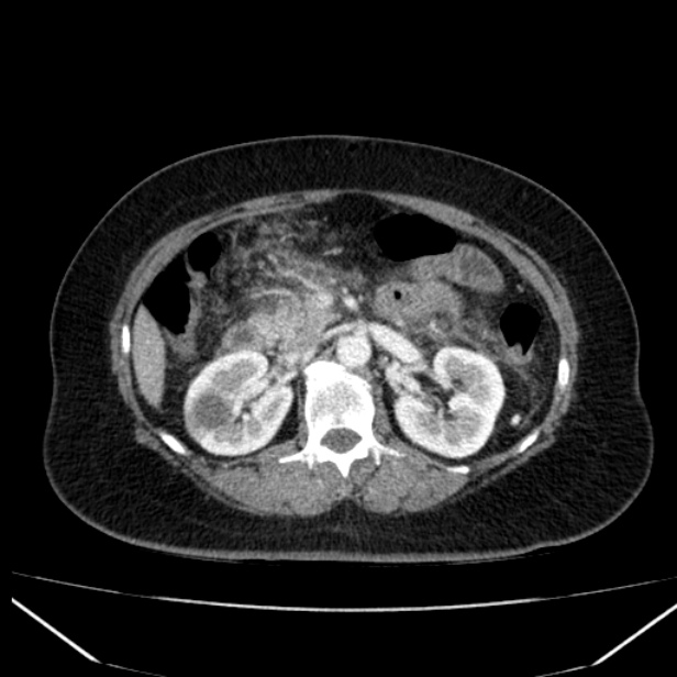 Acute pancreatitis - Balthazar C (Radiopaedia 26569-26714 Axial C+ arterial phase 36).jpg