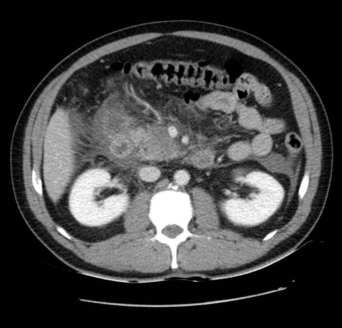 Acute pancreatitis - Balthazar E (Radiopaedia 23080-23110 Axial C+ portal venous phase 29).jpg