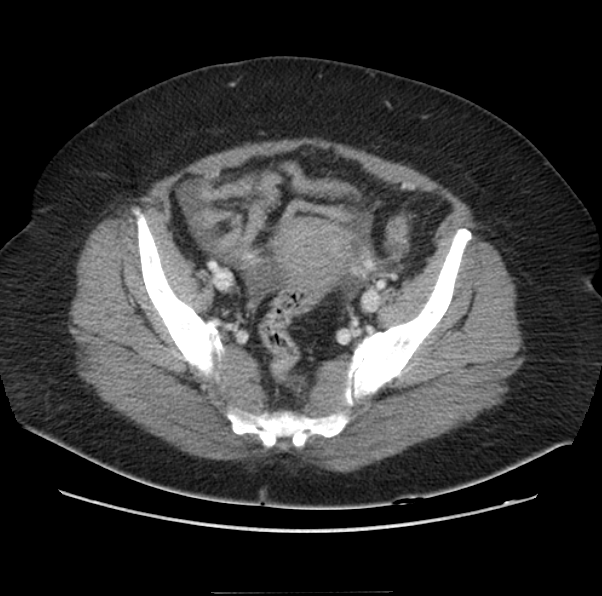 Acute pancreatitis - Balthazar E (Radiopaedia 29016-29377 Axial C+ portal venous phase 61).png