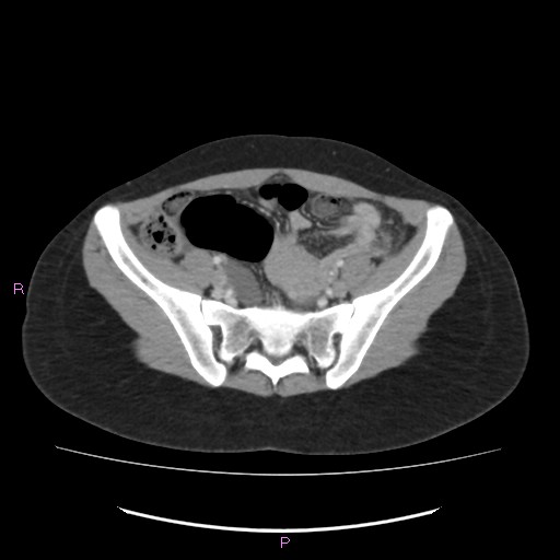 Acute pancreatitis secondary to stone at minor papilla and pancreatic divisum (Radiopaedia 76570-88333 Axial C+ portal venous phase 60).jpg