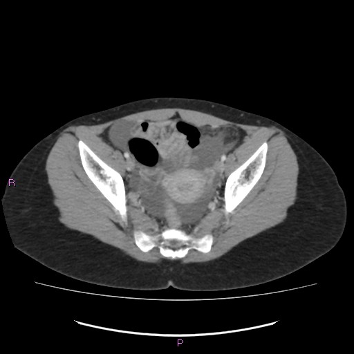 Acute pancreatitis secondary to stone at minor papilla and pancreatic divisum (Radiopaedia 76570-88333 Axial C+ portal venous phase 67).jpg