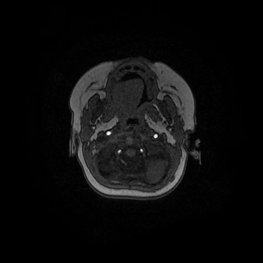 Acute phase of hemiconvulsion-hemiplegia epilepsy syndrome (Radiopaedia 29309-29745 Axial TOF angiography 153).jpg