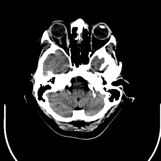 File:Acute pontine infarct from vertebral artery dissection (Radiopaedia 34111-35369 Axial non-contrast 5).png