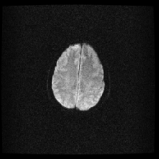 File:Acute pontine infarct from vertebral artery dissection (Radiopaedia 34111-35370 Axial DWI 16).png