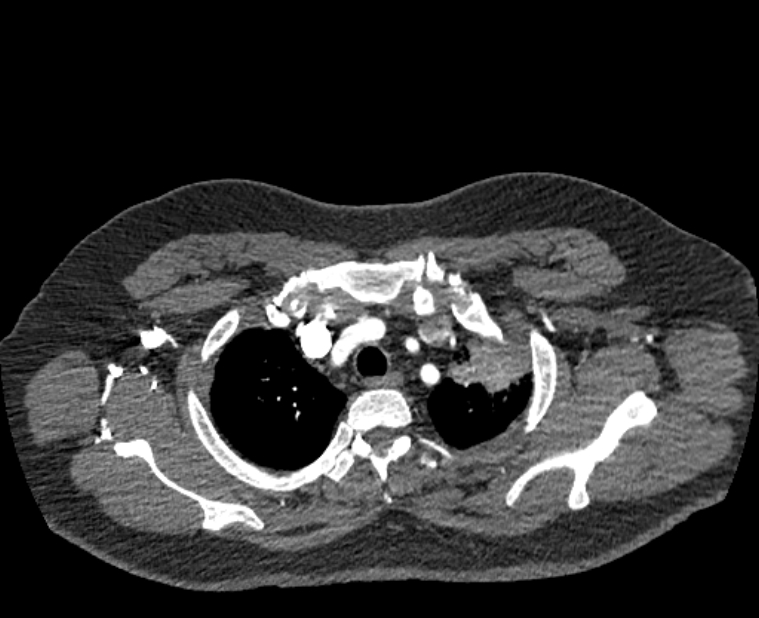 Acute pulmonary embolism with pulmonary infarcts (Radiopaedia 77688-89908 Axial C+ CTPA 6).jpg