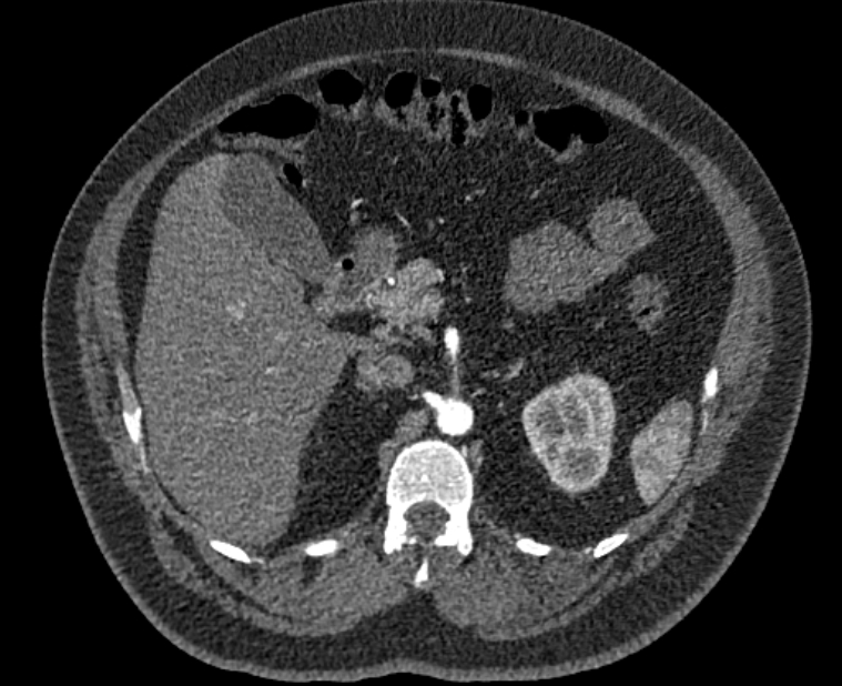 Acute pulmonary embolism with pulmonary infarcts (Radiopaedia 77688-89908 Axial C+ CTPA 84).jpg