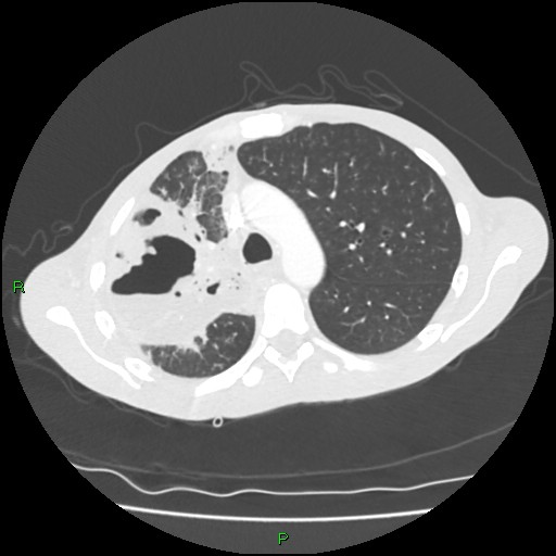 Acute right lung abscess (Radiopaedia 34806-36258 Axial lung window 59).jpg