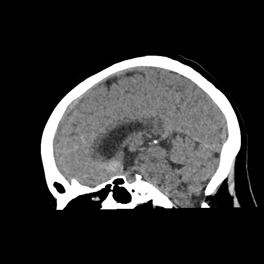 Acute subarachnoid hemorrhage and accessory anterior cerebral artery (Radiopaedia 69231-79008 Sagittal non-contrast 31).jpg