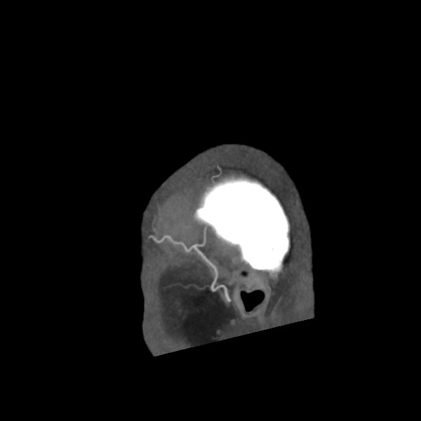 Acute subarachnoid hemorrhage and accessory anterior cerebral artery (Radiopaedia 69231-79009 Sagittal C+ arterial phase 69).jpg