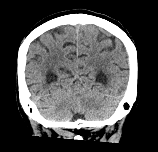 File:Acute traumatic subdural hematoma (Radiopaedia 82921-97257 Coronal non-contrast 64).jpg
