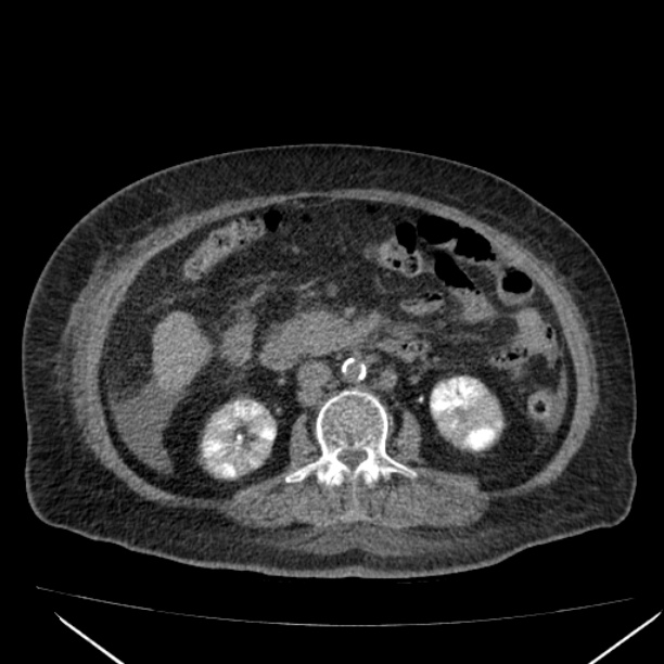 Acute tubular necrosis (Radiopaedia 28077-28334 F 34).jpg