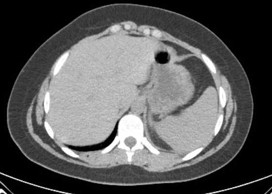 Acute unilateral nonhemorrhagic adrenal infarction (Radiopaedia 67560-76957 Axial non-contrast 10).jpg