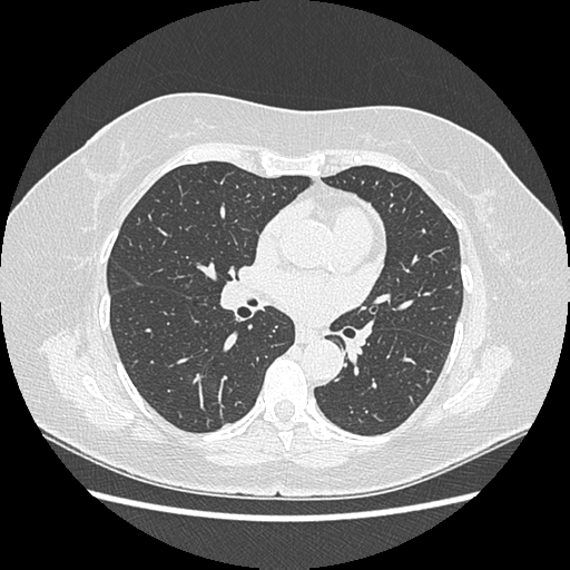 Adenocarcinoma in situ of lung (Radiopaedia 38685-40829 B 118).png