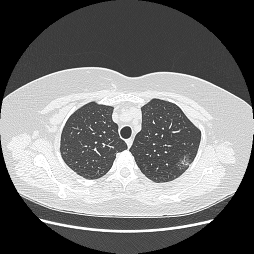 Adenocarcinoma in situ of lung (Radiopaedia 38685-40829 B 51).png