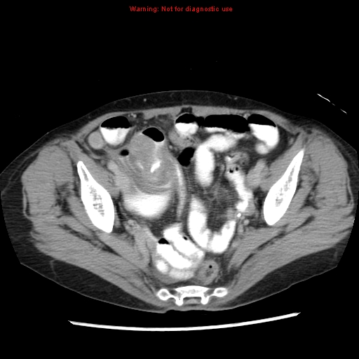 File:Adenocarcinoma of the colon (Radiopaedia 8191-9039 Axial renal excretory phase 50).jpg