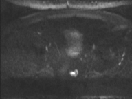 Adenocarcioma of rectum- T1 lesion (Radiopaedia 36921-38546 Axial DWI 47).png