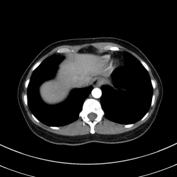 Adenocystic carcinoma of the trachea (Radiopaedia 47677-52525 Axial C+ arterial phase 71).jpg