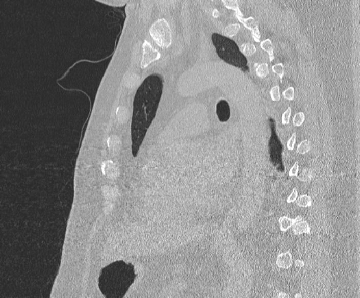 File:Adenoid cystic carcinoma of the trachea (Radiopaedia 49042-54137 Sagittal lung window 268).jpg