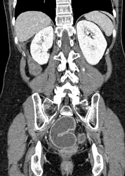Adhesional small bowel obstruction (Radiopaedia 48397-53305 Coronal C+ portal venous phase 260).jpg