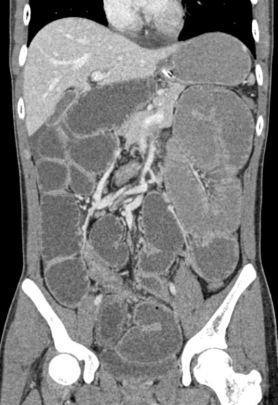 Adhesional small bowel obstruction (Radiopaedia 52107-57980 Coronal C+ portal venous phase 36).jpg