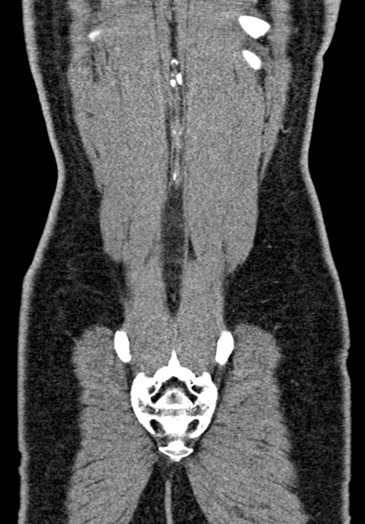 Adhesional small bowel obstruction (Radiopaedia 58900-66131 Coronal C+ portal venous phase 221).jpg