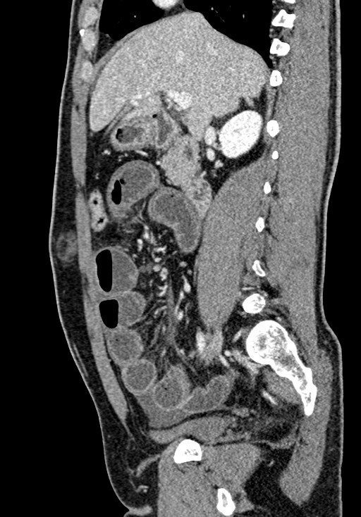 Adhesional small bowel obstruction (Radiopaedia 58900-66131 Sagittal C+ portal venous phase 98).jpg