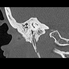 File:Adhesive chronic otitis media (Radiopaedia 14270-14148 Coronal bone window - right 17).jpg