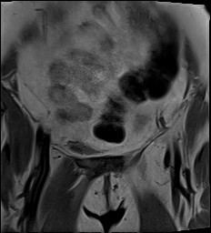 File:Adnexal multilocular cyst (O-RADS US 3- O-RADS MRI 3) (Radiopaedia 87426-103754 Coronal 6).jpg