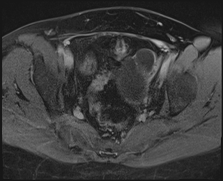 File:Adnexal multilocular cyst (O-RADS US 3. O-RADS MRI 3) (Radiopaedia 87426-103754 Axial 235).jpeg
