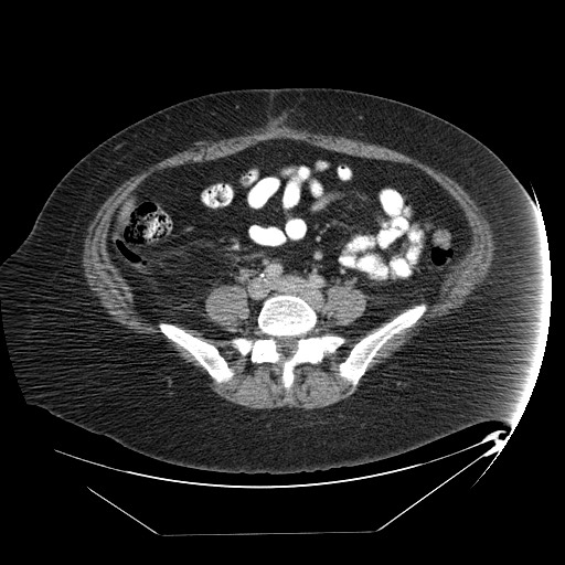 File:Adrenal angiosarcoma (Radiopaedia 81081-94671 Axial C+ portal venous phase 54).jpg
