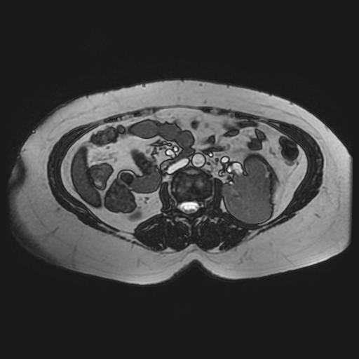 File:Adrenal cortical carcinoma (Radiopaedia 70906-81116 Axial FIESTA 37).jpg