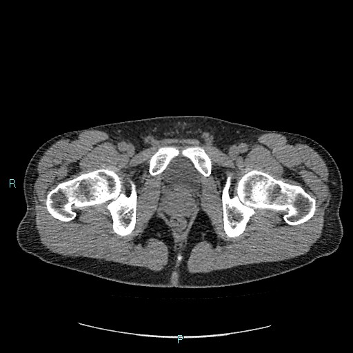 File:Adrenal cystic lymphangioma (Radiopaedia 83161-97534 Axial non-contrast 99).jpg
